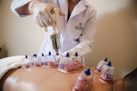 Hijama Cupping Therapy — Back